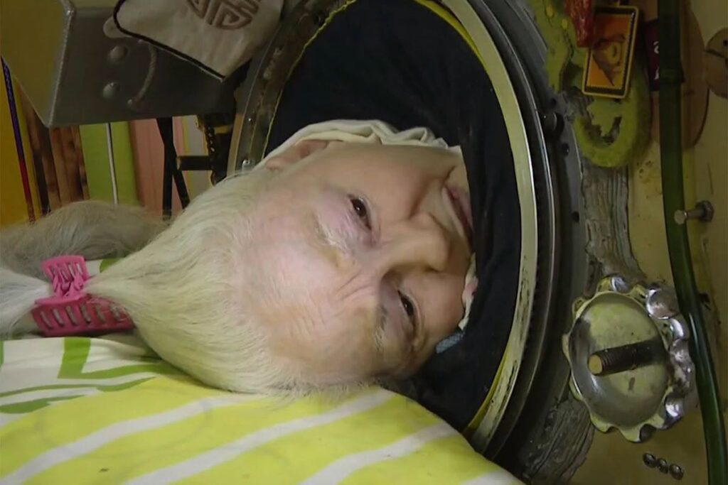 Martha Lillard Obituary: Last Known American Iron Lung User and Polio Survivor Dies at 78 After Long COVID Complications
